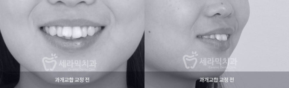 딥바이트(과개교합) 때문에 감추고 싶던 치아, 치아교정전후 달라진 미소 관련 이미지 1