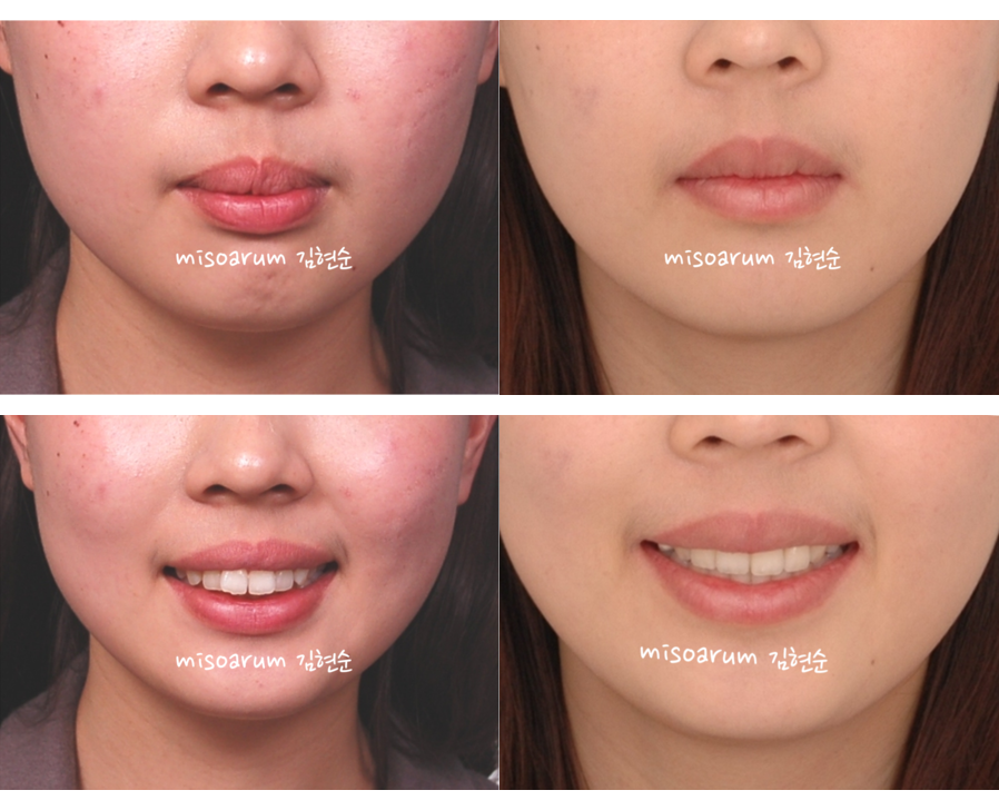 세라믹교정 세라믹치과-돌출입발치교정 2 관련 이미지 7