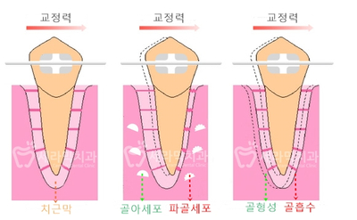 치아교정 부작용 제대로 알기 1. 관련 이미지 5