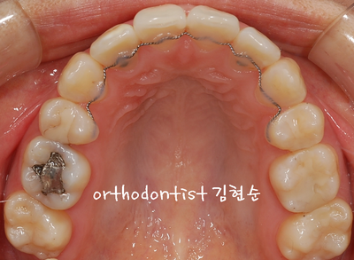 강남 돌출 관련 이미지 23