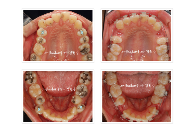 돌출입 발치교정, 미니스크류를 통한 6가지 변화 관련 이미지 8