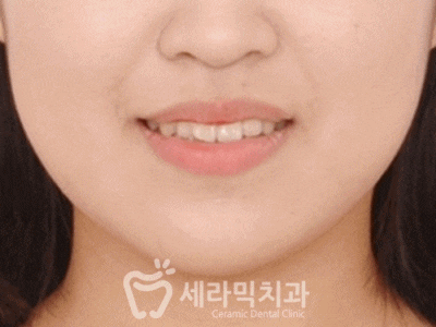 돌출입 세라믹교정으로 자신감 up! 세련미 완성! 관련 이미지 1