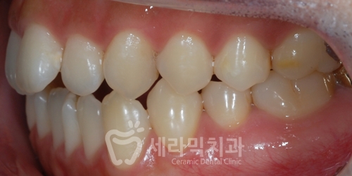 Open Bite Dental Clinic Orthodontic Before and After: Did a Long-Looking Jaw Become Shorter? image 7