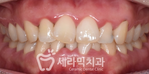 과개교합과 삐뚤빼뚤한 치열, 돌출입 앞니 치아교정전후 관련 이미지 1