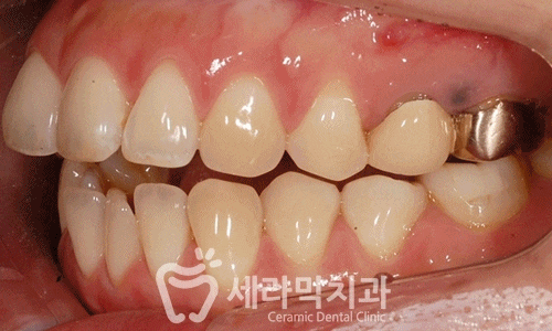 상실된 치아가 있어도, 금니가 있어도 치아교정전후는 계속된다! 관련 이미지 7