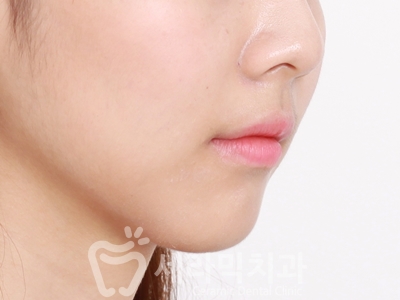 과개교합 치아교정잘하는곳, 세라믹치과 치아교정전후! 관련 이미지 23