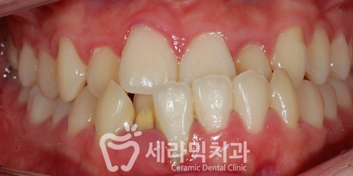 반대교합과 돌출입 고민, 세라믹교정으로 해결 완료! 관련 이미지 2