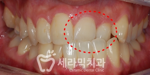 세라믹치과 치아교정전후 : 앞니반대교합+치열불규칙 관련 이미지 2