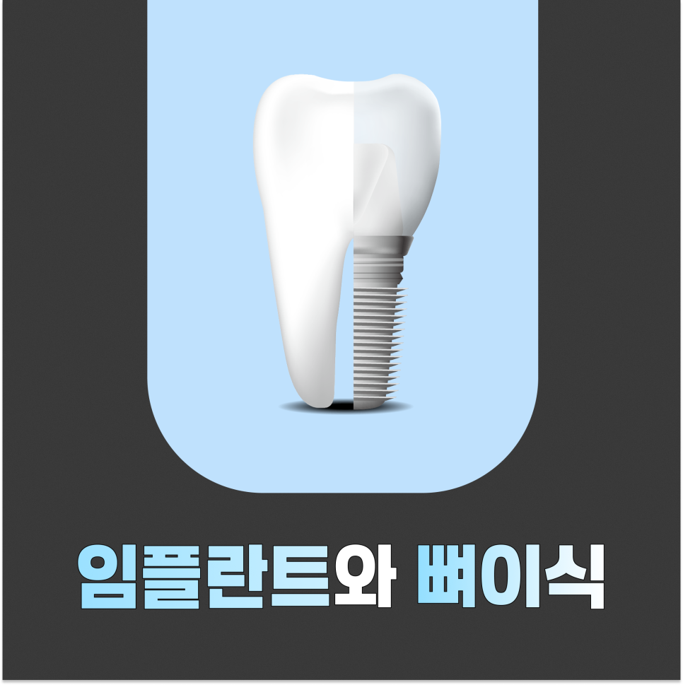 '임플란트 뼈이식' 전에 알아야 할 3가지 관련 이미지 1