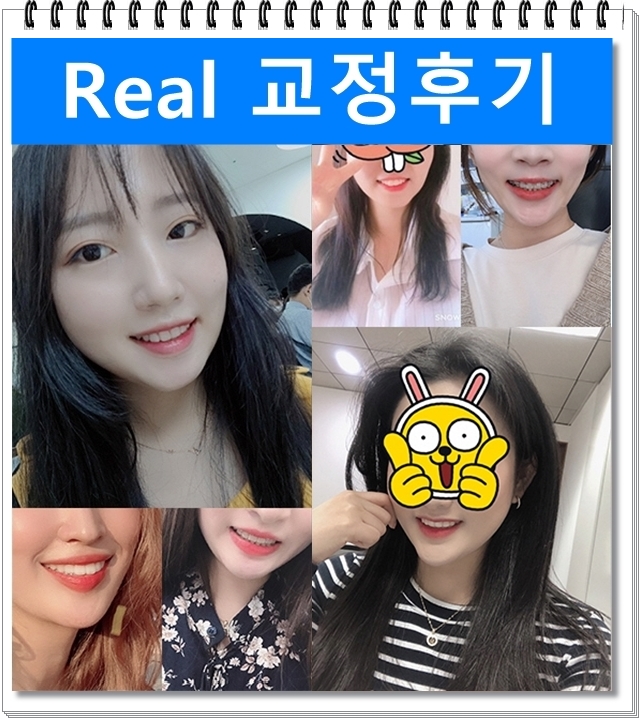 돌출입과 개방교합, 치아교정전후 자신감 UP! 치아건강 UP! 관련 이미지 3