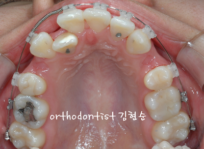 강남 돌출 관련 이미지 16