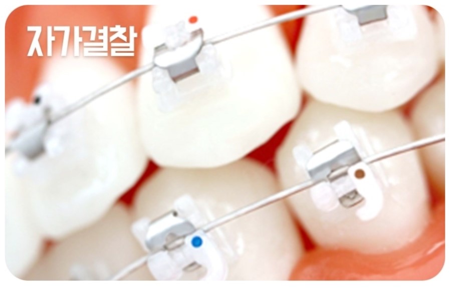 세라믹교정 클리피씨 데이몬 차이점 요약 관련 이미지 4