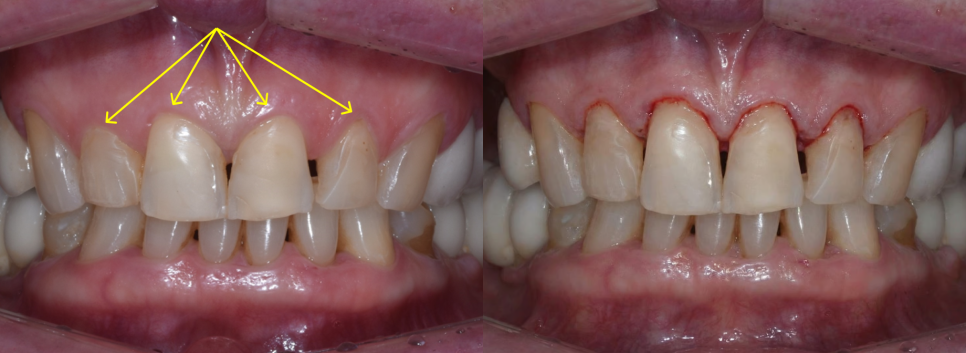 강남구청역 치과, 70대 외국인 환자의 라미네이트 관련 이미지 6