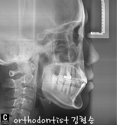 치열 교정 ( 벌어짐 ) 관련 이미지 27