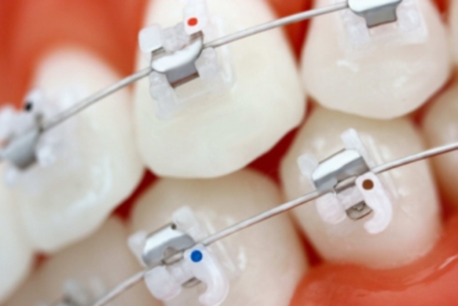 클리피씨교정 기간 짧을까? 관련 이미지 9