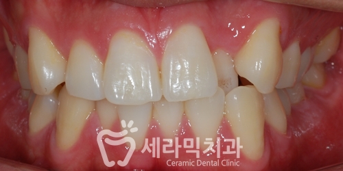 치아배열 치아교정전후 : 함박웃음을 찾은 사례 관련 이미지 3