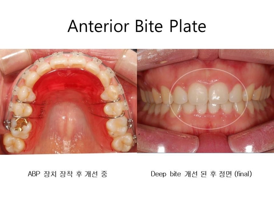 학동역치과 치아교정 잘하는 곳 ! 관련 이미지 12