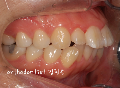 강남 돌출 관련 이미지 8