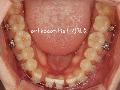 치열 교정 ( 벌어짐 ) 관련 이미지 19