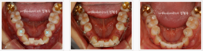 강남 덧니 관련 이미지 11
