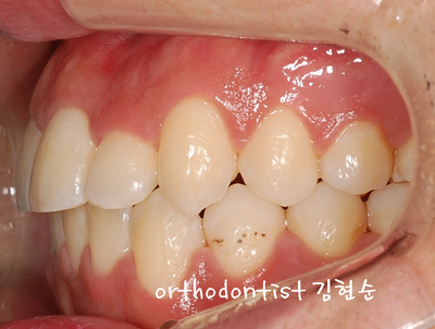 반대교합 관련 이미지 23