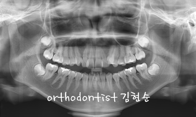 강남 덧니 관련 이미지 32