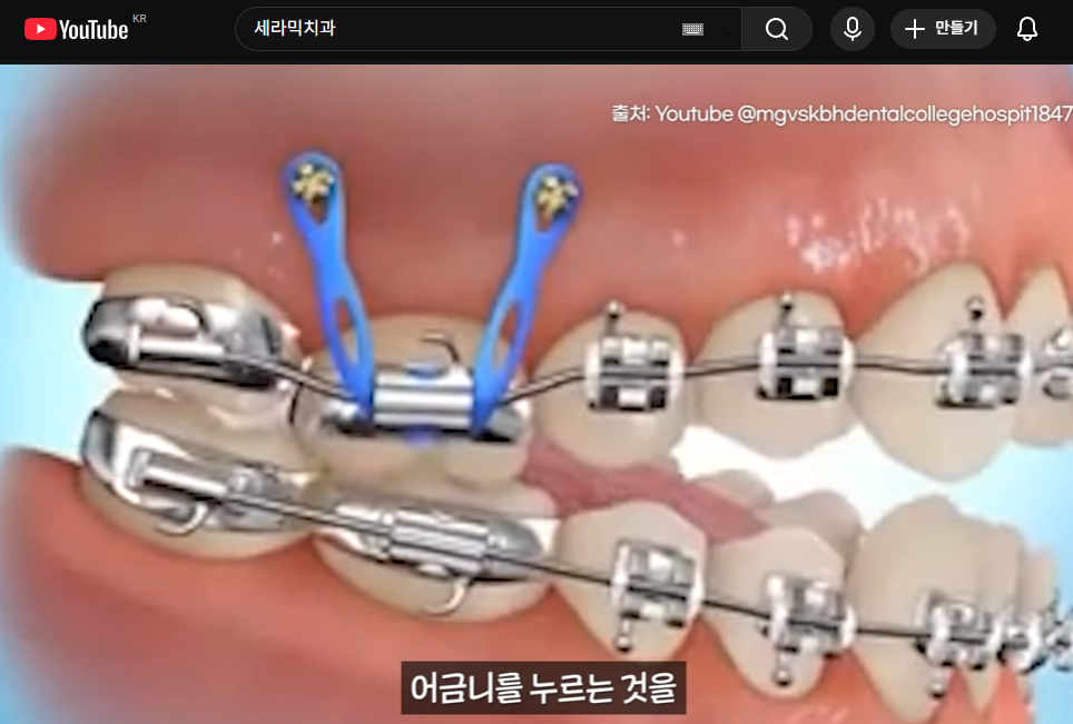 개방교합은 재발률이 높다? 치아교정 후 관리방법 (feat.유지장치) 관련 이미지 4