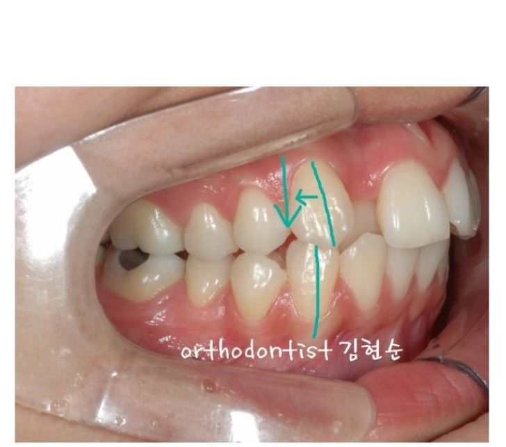 세라믹치과 수술없이 돌줄입교정 관련 이미지 3
