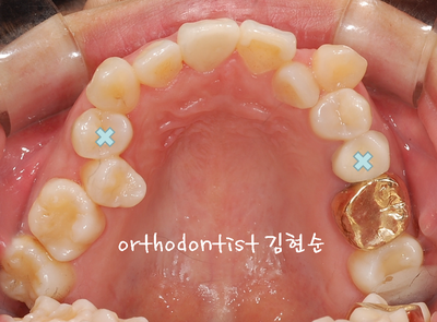 강남 덧니, 돌출 관련 이미지 14
