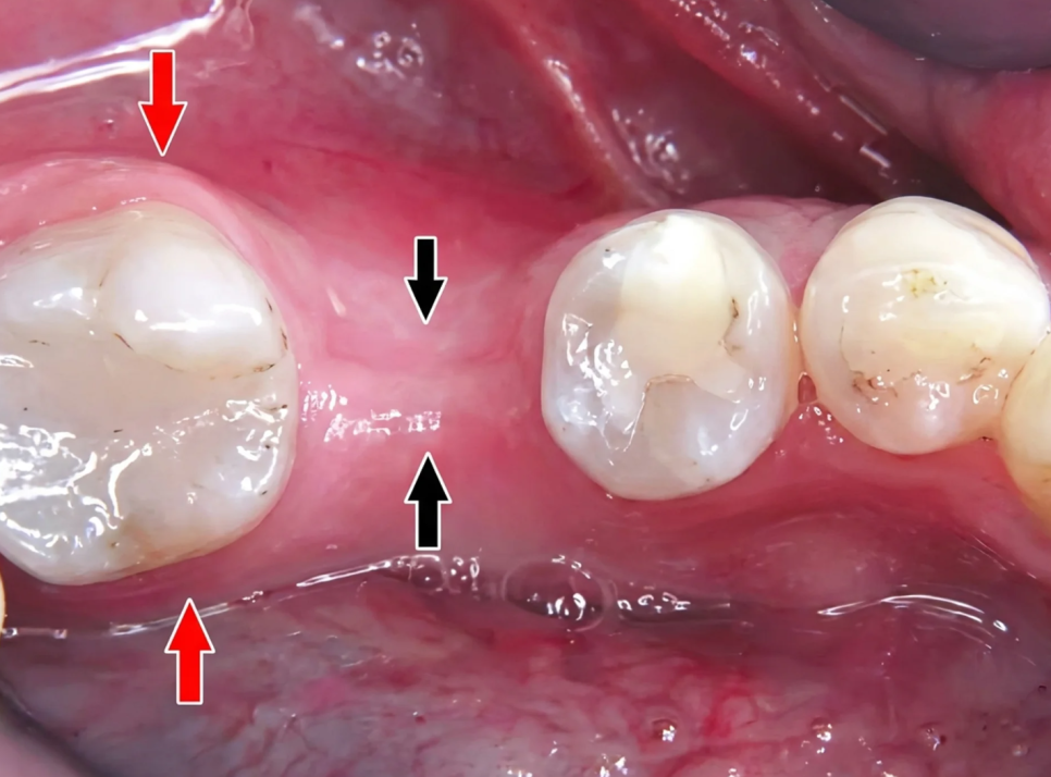 역삼동 치과, 임플란트 안 심고 살면 안 되나요? 관련 이미지 4