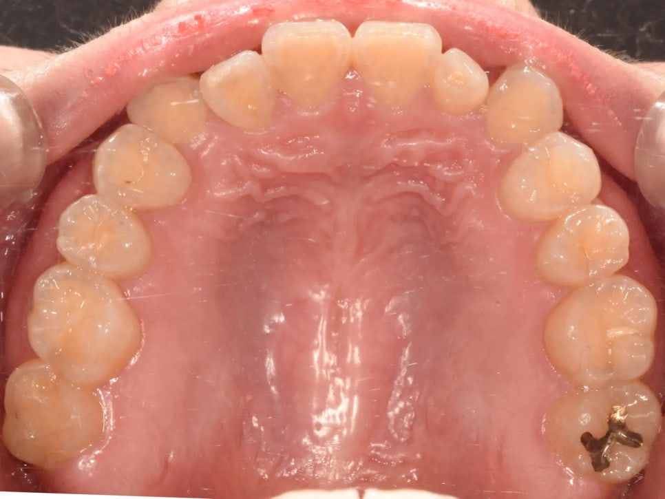언주역 치과, 주걱턱 + 과개교합을 비수술로 치료한 사례 관련 이미지 5