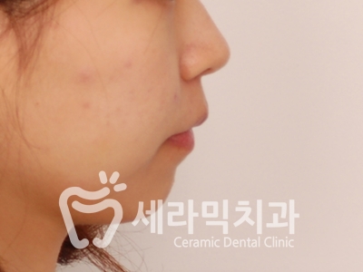 돌출입 잇몸노출 치아교정 전후 인상변화 사례 관련 이미지 16