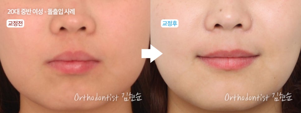 학동역치과 치아교정은 여기서 !! 관련 이미지 19