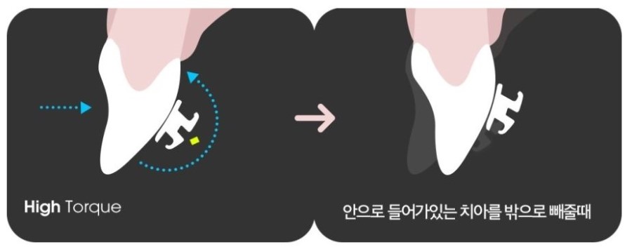 돌출입교정 옥니 부작용 방지 교정브라켓 관련 이미지 4
