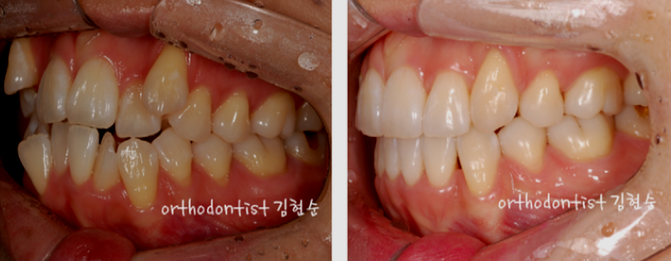 강남 덧니 관련 이미지 15