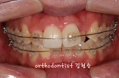 반대교합 관련 이미지 13