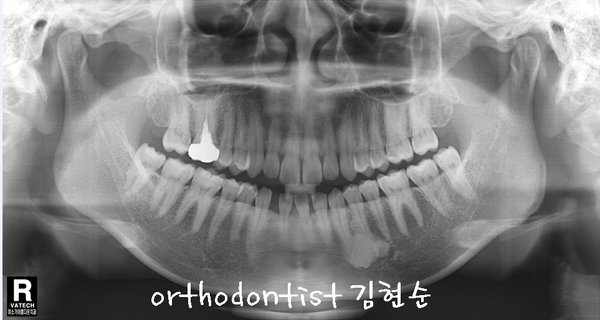 치열 교정 ( 벌어짐 ) 관련 이미지 12