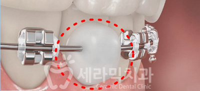 치아교정을 하면 입 냄새가 많이 나요? 관련 이미지 5