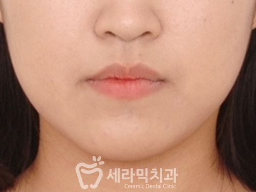 돌출입교정으로 갸름한 턱라인까지 되찾다! 돌출입 치아교정전후 관련 이미지 4