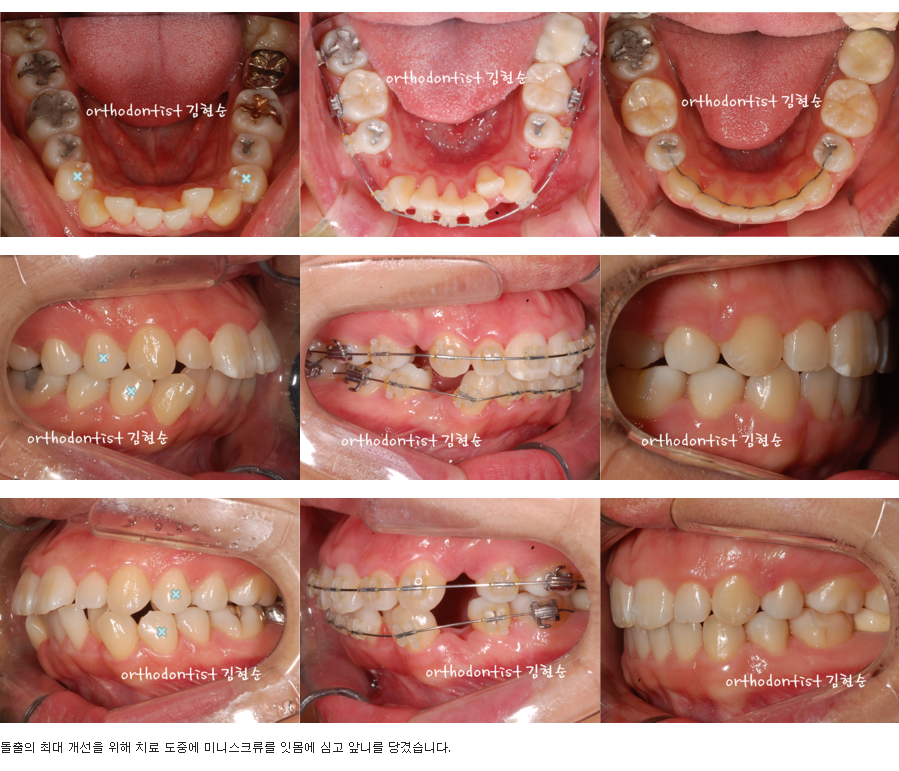 세라믹교정 세라믹치과-돌출입발치교정 5 관련 이미지 4