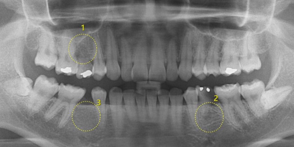 나비치아, 앞니돌출, 과개교합 치아교정전후 관련 이미지 3