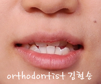 강남 덧니 관련 이미지 26