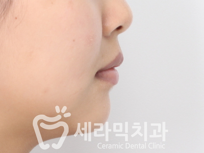토끼이빨, 틀어진 치아배열 세라믹교정 전후사진 관련 이미지 21