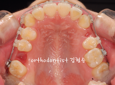 치열 교정(치열 불규칙) 관련 이미지 21