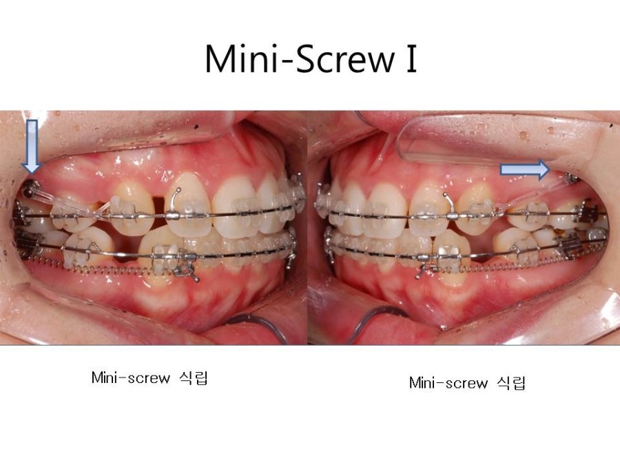 학동역치과 치아교정 잘하는 곳 ! 관련 이미지 17