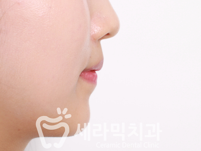 치아교정 전후 스마일라인 변화!(돌출입,토끼앞니, 중심선 비대칭 동시 교정) 관련 이미지 15