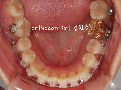 강남 덧니, 돌출 관련 이미지 21