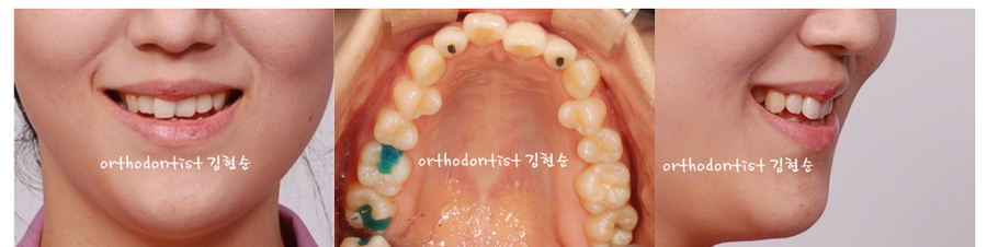 개방교합 비발치 세라믹교정 관련 이미지 6