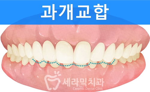 과개교합 치아교정 전후 올라간 입꼬리! 관련 이미지 1