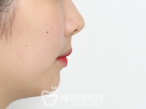 돌출입교정, 심미성과 치아 건강을 동시에 해결! 관련 이미지 26